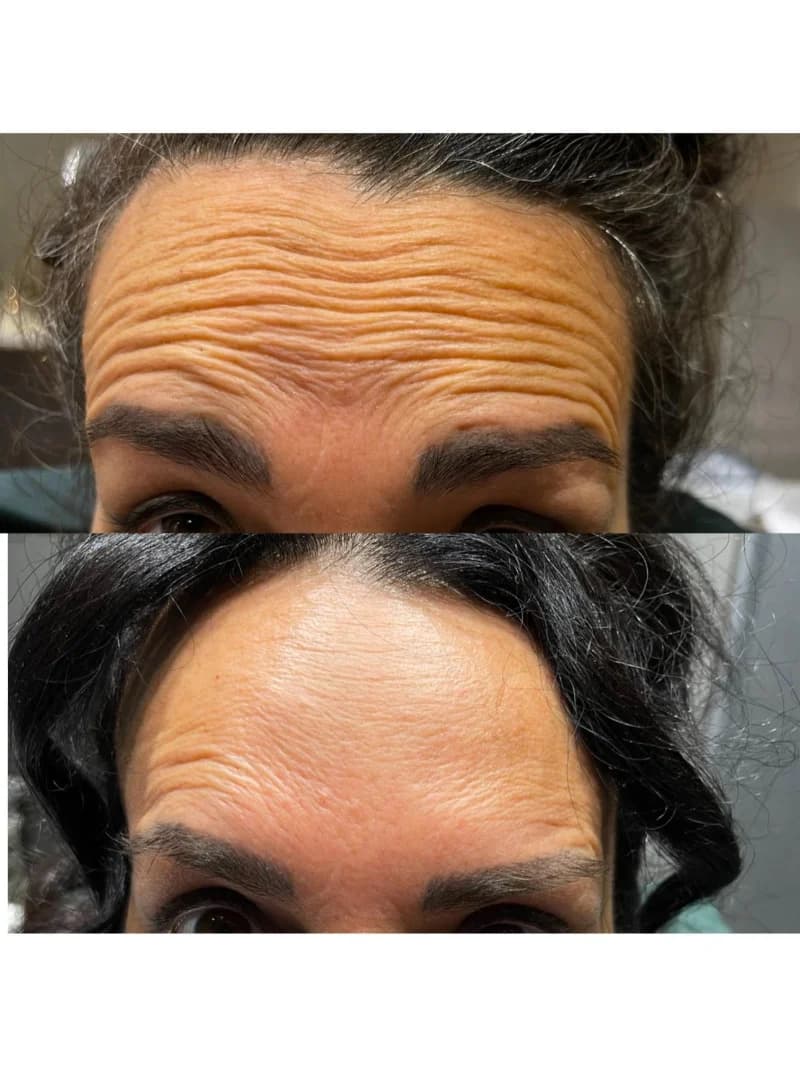 Anti-Wrinkle Results