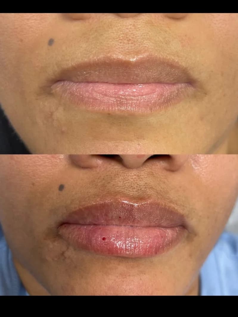 Dermal Filler Look